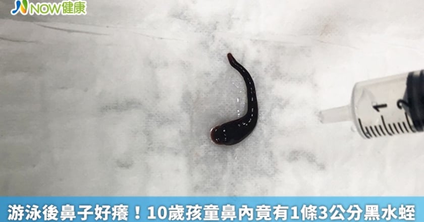游泳後鼻子好癢! 10歲孩童鼻內竟有1條3公分黑水蛭