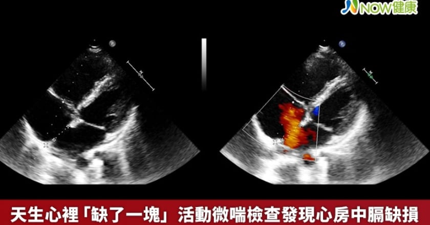 天生心裡「缺了一塊」 活動微喘檢查發現心房中膈缺損