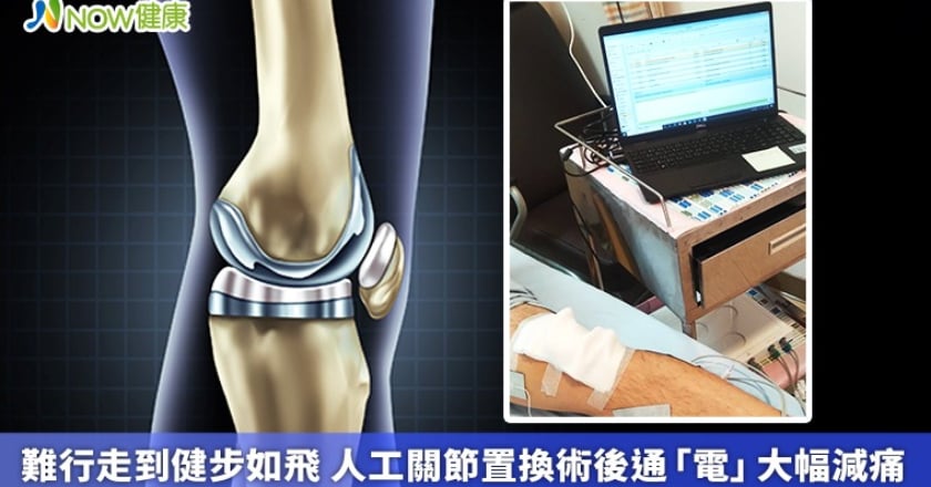 難行走到健步如飛 人工關節置換術後通「電」大幅減痛