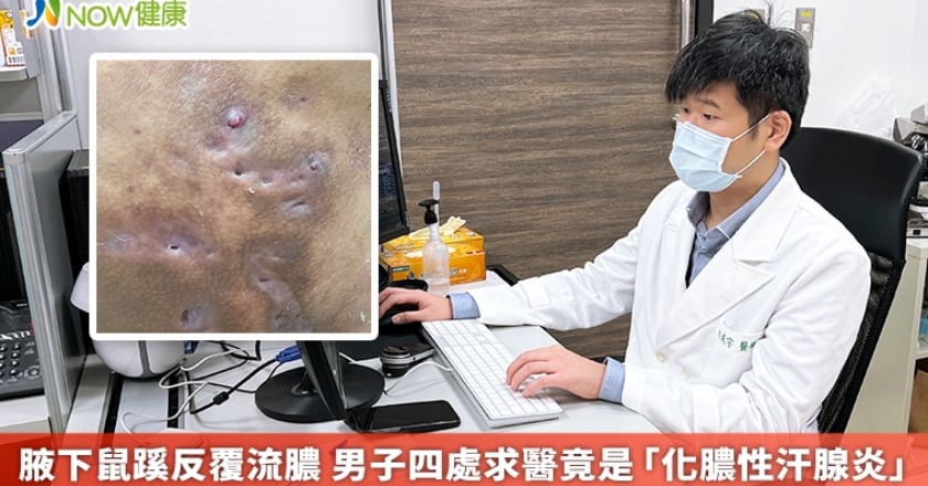 腋下鼠蹊反覆流膿 男子四處求醫竟是「化膿性汗腺炎」
