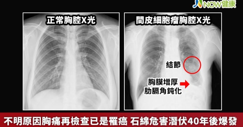 不明原因胸痛再檢查已是罹癌 石綿危害潛伏40年後爆發