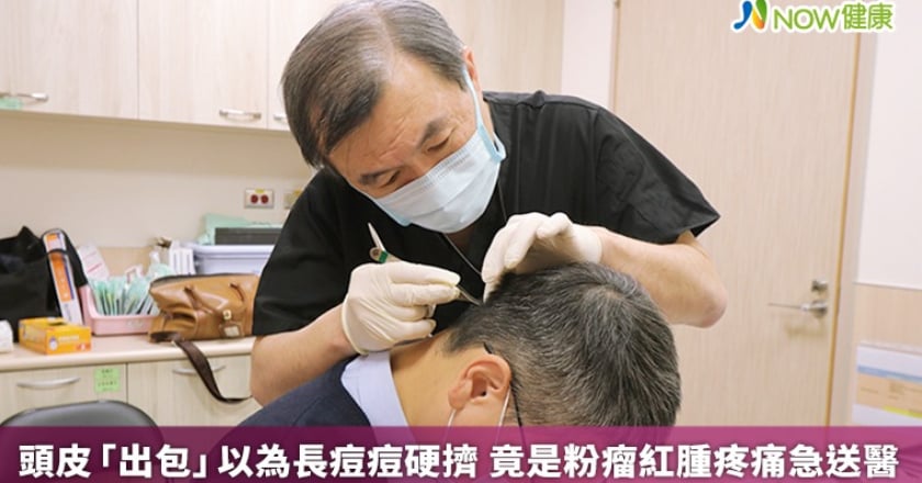 頭皮「出包」以為長痘痘硬擠 竟是粉瘤紅腫疼痛急送醫