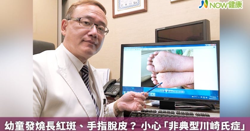 幼童發燒長紅斑、手指脫皮? 小心「非典型川崎氏症」