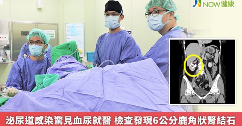 泌尿道感染驚見血尿就醫 檢查發現6公分鹿角狀腎結石
