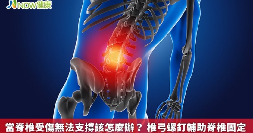 當脊椎受傷無法支撐該怎麼辦？ 椎弓螺釘輔助脊椎固定