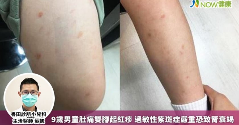 9歲男童肚痛雙腳起紅疹 過敏性紫斑症嚴重恐致腎衰竭