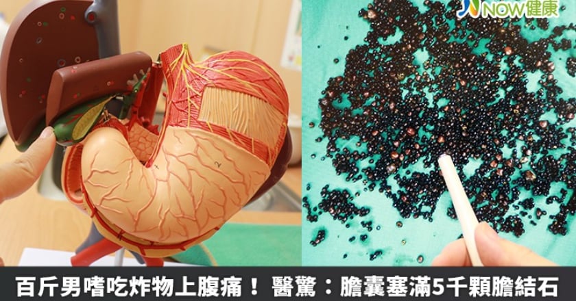 百斤男嗜吃炸物上腹痛! 醫驚:膽囊塞滿5千顆膽結石