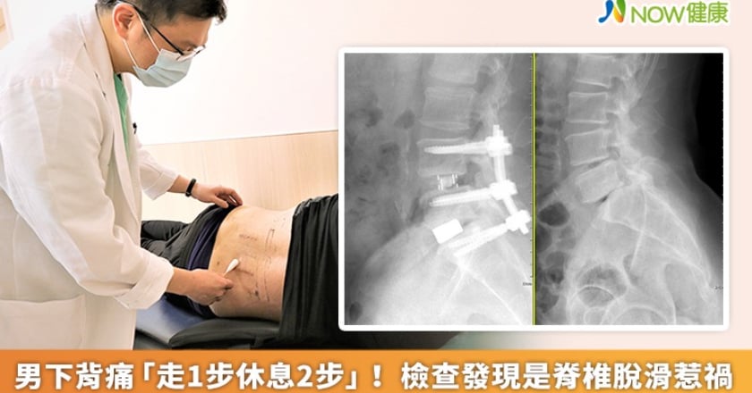 男下背痛「走1步休息2步」！ 檢查發現是脊椎脫滑惹禍