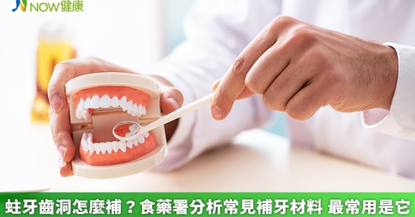 蛀牙齒洞怎麼補？食藥署分析常見補牙材料 最常用是它