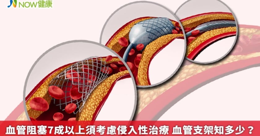 血管阻塞7成以上須考慮侵入性治療 血管支架知多少？