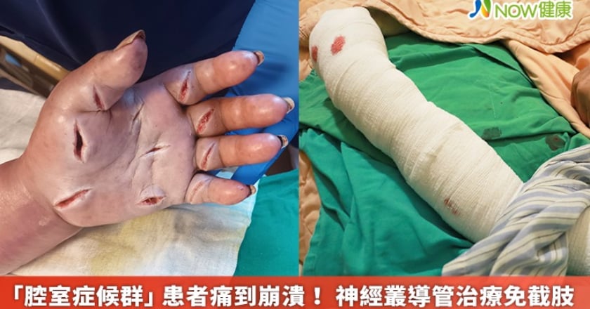 「腔室症候群」患者痛到崩潰! 神經叢導管治療免截肢