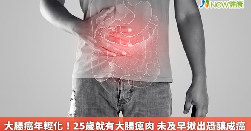 大腸癌年輕化！25歲就有大腸瘜肉 未及早揪出恐釀成癌