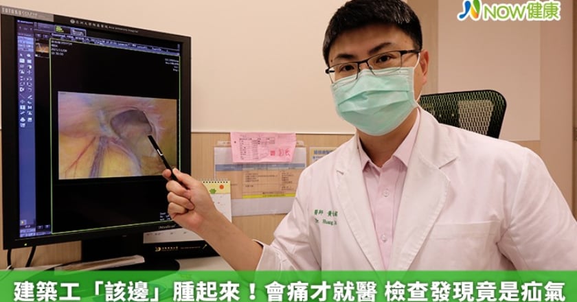 建築工「該邊」腫起來!會痛才就醫 檢查發現竟是疝氣