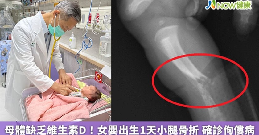 母體缺乏維生素D!女嬰出生1天小腿骨折 確診佝僂病