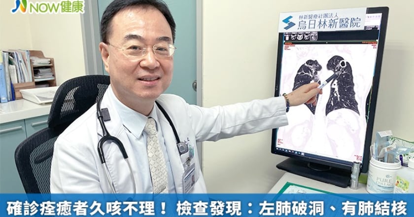 確診痊癒者久咳不理！ 檢查發現：左肺破洞、有肺結核
