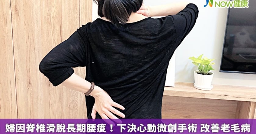 婦因脊椎滑脫長期腰痠！下決心動微創手術 改善老毛病