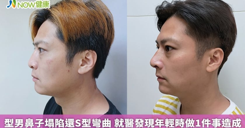 型男鼻子塌陷還S型彎曲 就醫發現年輕時做1件事造成