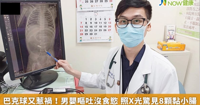 巴克球又惹禍!男嬰嘔吐沒食慾 照X光驚見8顆黏小腸
