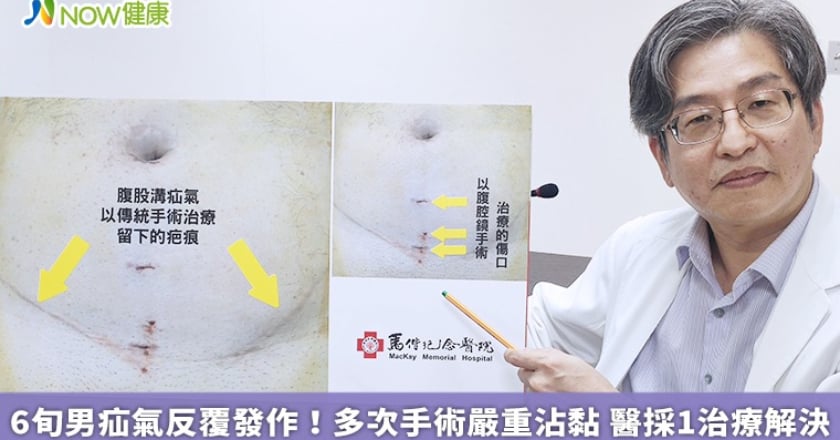 6旬男疝氣反覆發作！多次手術嚴重沾黏 醫採1治療解決