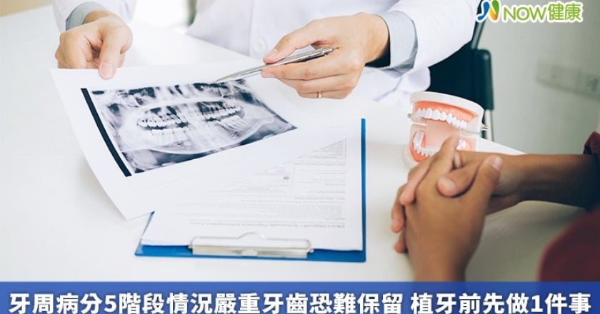 牙周病分5階段情況嚴重牙齒恐難保留 植牙前先做1件事