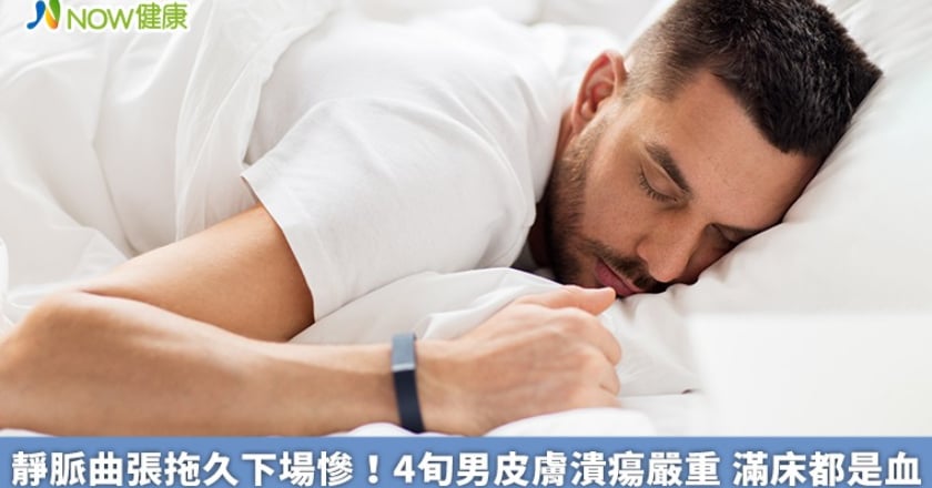 靜脈曲張拖久下場慘!4旬男皮膚潰瘍嚴重 滿床都是血
