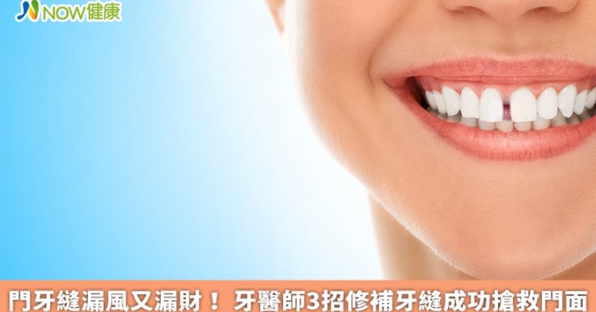 門牙縫漏風又漏財！ 牙醫師3招修補牙縫成功搶救門面