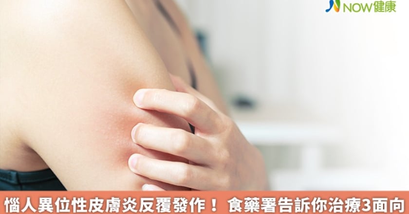 惱人異位性皮膚炎反覆發作! 食藥署告訴你治療3面向