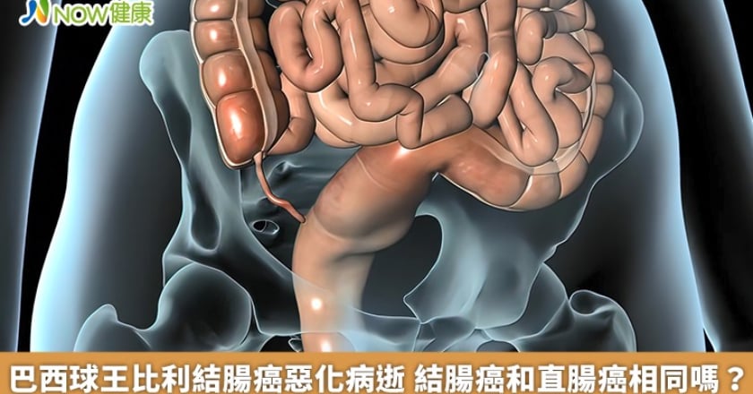 巴西球王比利結腸癌惡化病逝 結腸癌和直腸癌相同嗎？