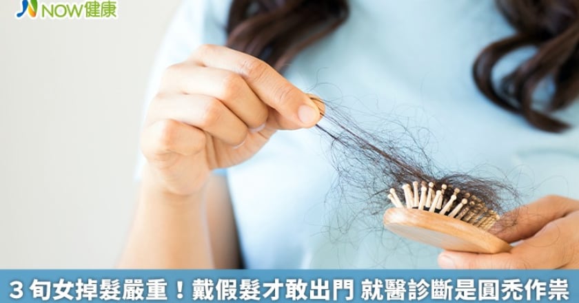 3旬女掉髮嚴重！戴假髮才敢出門 就醫診斷是圓禿作祟
