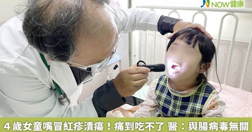 4歲女童嘴冒紅疹潰瘍！痛到吃不了 醫：與腸病毒無關
