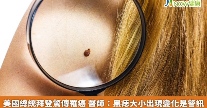 美國總統拜登驚傳罹癌 醫師：黑痣大小出現變化是警訊