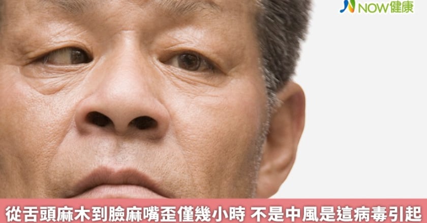 從舌頭麻木到臉麻嘴歪僅幾小時 不是中風是這病毒引起
