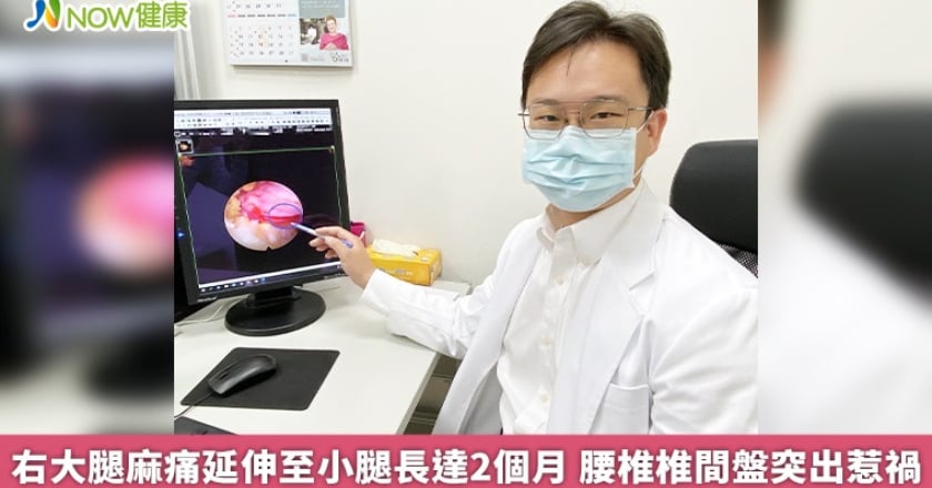 右大腿麻痛延伸至小腿長達2個月 腰椎椎間盤突出惹禍