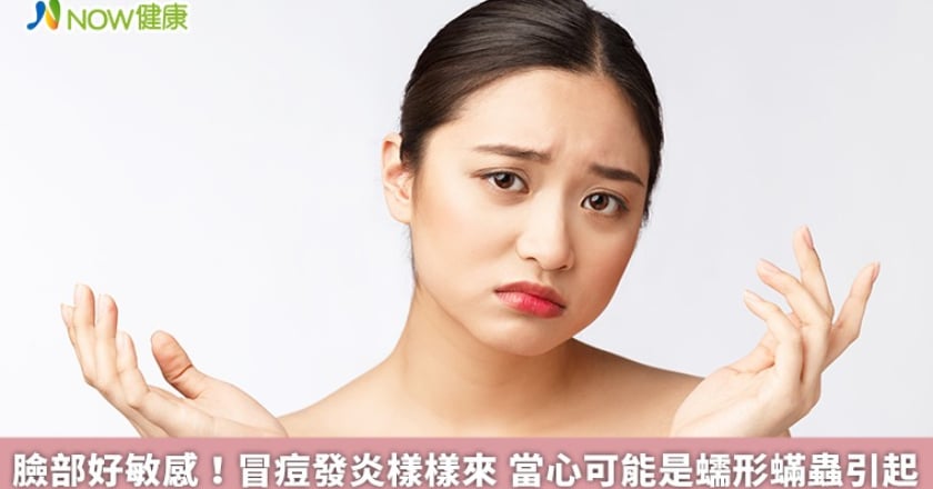 臉部好敏感!冒痘發炎樣樣來 當心可能是蠕形蟎蟲引起