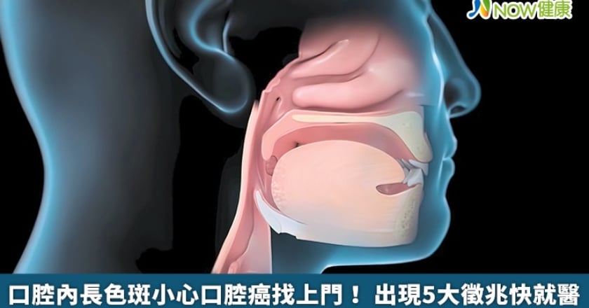 口腔內長色斑小心口腔癌找上門！ 出現5大徵兆快就醫