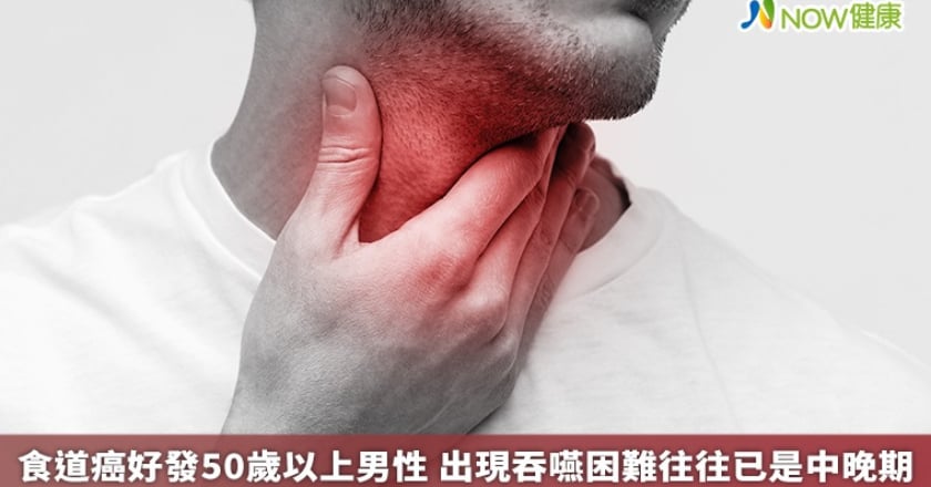 食道癌好發50歲以上男性 出現吞嚥困難往往已是中晚期