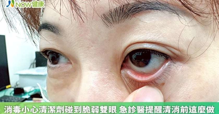 消毒小心清潔劑碰到脆弱雙眼 急診醫提醒清消前這麼做