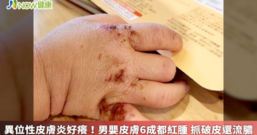 異位性皮膚炎好癢！男嬰皮膚6成都紅腫 抓破皮還流膿
