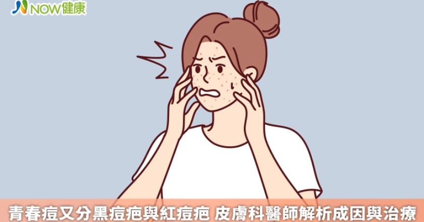 青春痘又分黑痘疤與紅痘疤 皮膚科醫師解析成因與治療