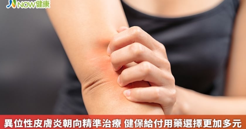 異位性皮膚炎朝向精準治療 健保給付用藥選擇更加多元