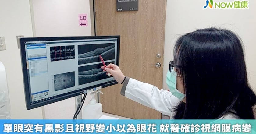 單眼突有黑影且視野變小以為眼花 就醫確診視網膜病變
