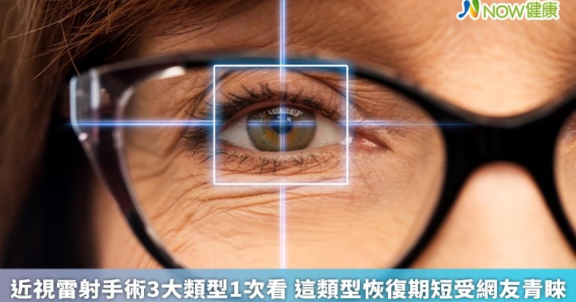 近視雷射手術3大類型1次看 這類型恢復期短受網友青睞