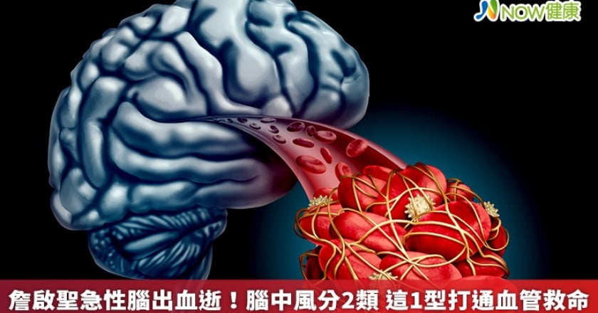 詹啟聖急性腦出血逝!腦中風分2類 這1型打通血管救命