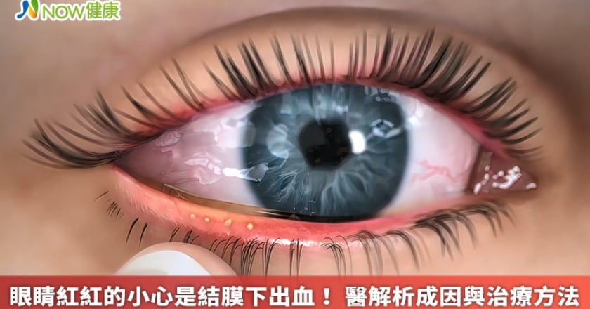眼睛紅紅的小心是結膜下出血！ 醫解析成因與治療方法
