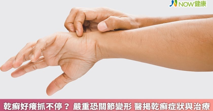 乾癬好癢抓不停？嚴重恐關節變形 醫揭乾癬症狀與治療