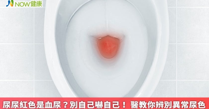 尿尿紅色是血尿?別自己嚇自己! 醫教你辨別異常尿色