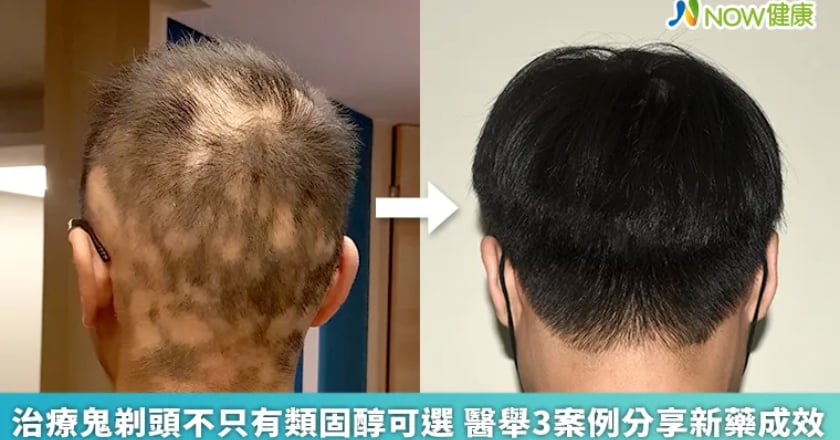 治療鬼剃頭不只有類固醇可選 醫舉3案例分享新藥成效