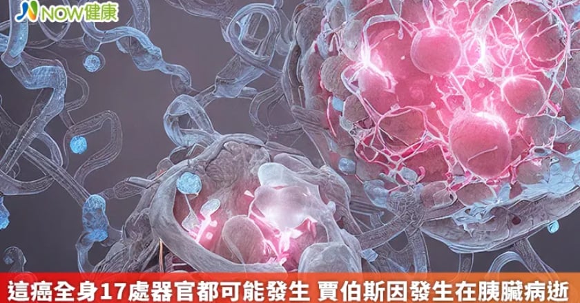 這癌全身17處器官都可能發生 賈伯斯因發生在胰臟病逝