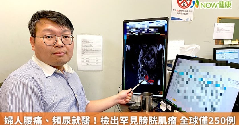 婦人腰痛、頻尿就醫!檢出罕見膀胱肌瘤 全球僅250例
