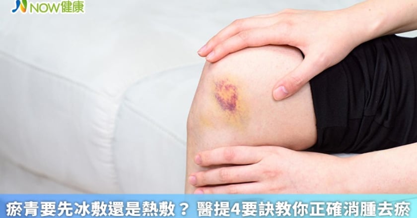 瘀青要先冰敷還是熱敷？ 醫提4要訣教你正確消腫去瘀